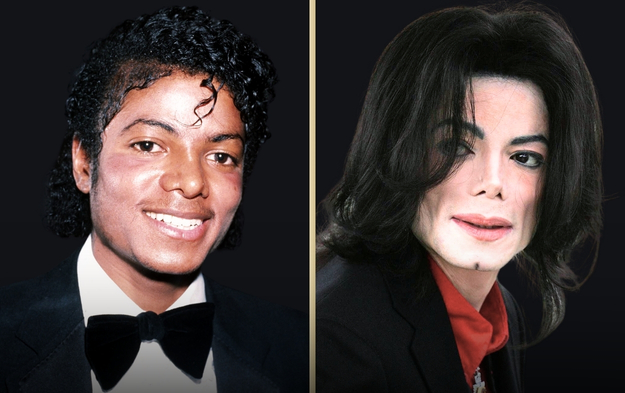 nose job michael jackson